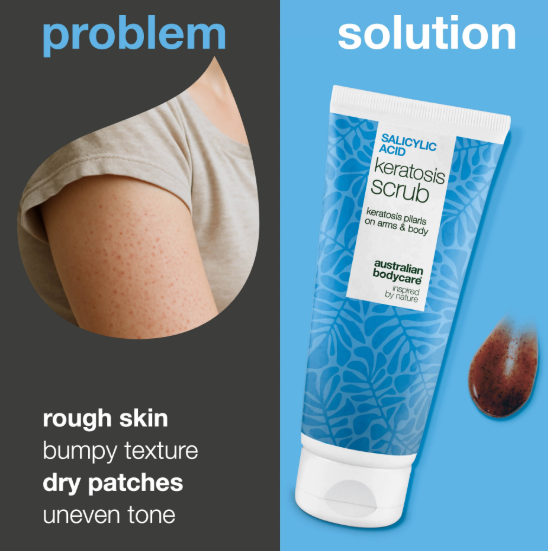 Body Exfoliation for Keratosis Pilaris